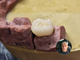 Case Author: Lorena  From：Mexico Material: Lithium-Disilicate-Ingot