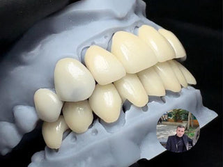 Case Author: David From：Mexico Material: Lithium-Disilicate-Ingot