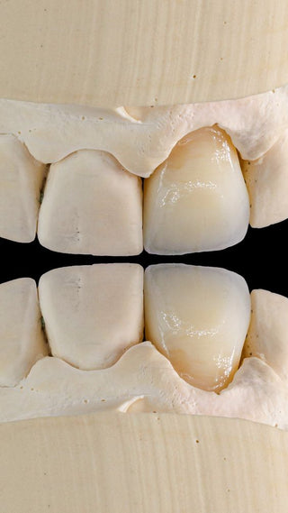 Effect of occlusal thickness design on fracture resistance of inner crowns of lithium disilicate ceramic and zirconia restorations