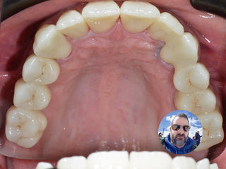 2024-12-03 case:   From:Mexico   Author:Jorge  Material:ST+Color zirconia