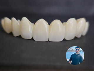 2024-11-25 case:   From:Mexico   Author:Ricardo    Material:3D Pro Multilayer zirconia