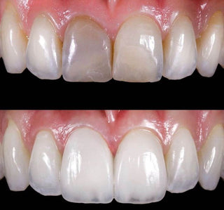 Effect of repeated sintering and variations in thickness on the color and microstructure of dental lithium disilicate-based glass ceramic veneers