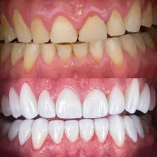 Glass Ceramic Ingot (Press Lithium Disilicate)—HT/LT 10 Pieces