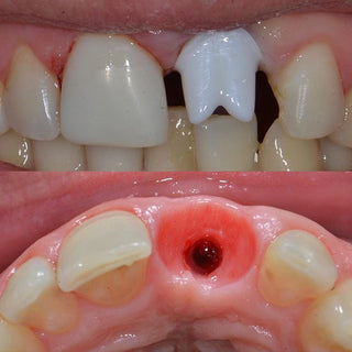 HT Bloco de Zircônia Branca Sistema Sirona 5 Peças