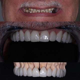 Lithium Disilicate Blocks(Glass Ceramic)—C14/B32/B40-HT/LT 5 Pieces