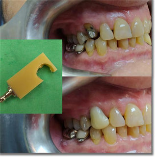 PMMA Monochrome Block Sirona System