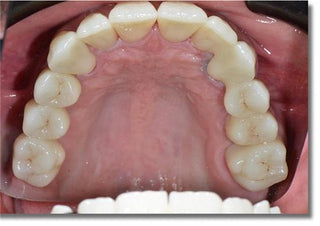 ST+C Precolored Zirconia Block Sirona System  5 Pieces