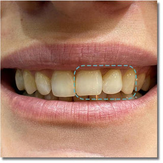 UTEx Pro Multilayer Zirconia Block Zirkonzahn System  95mm